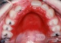 Candidose am harten Gaumen als Folge von Zahnersatz