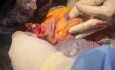 En-bloc-Entnahme und -Transplantation von Herz und Lunge – Technik und wichtige Aspekte