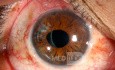 Follow-up: stumpfes okuläres Trauma, Phakotrabekulektomie und Rekonstruktion von Irisdefekten