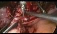 Laparoskopische Isthmozelen-Reparatur nach 2 vorangegangenen Kaiserschnitten des unteren Uterus