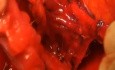 Radikale Hysterektomie - Resektion des Ligamentum vesicouterinums