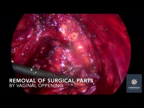 Endometriose des Uterus und der Harnblase, Tumor am Nervus obturatorius