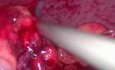 Durchtrennen der Magensonde während der Schlauchmagenresektion