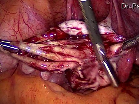 Die Entfernung von Endometriosezyste des Eierstocks