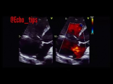 11. Was sehen Sie in der Echokardiographie?