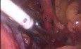 Laparoskopische Dissektion der Beckenlymphknoten