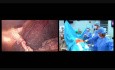 Die Operation  der ursprünglichen Nabelhernie mit der laparoskopischen Chirurgie IPOM
