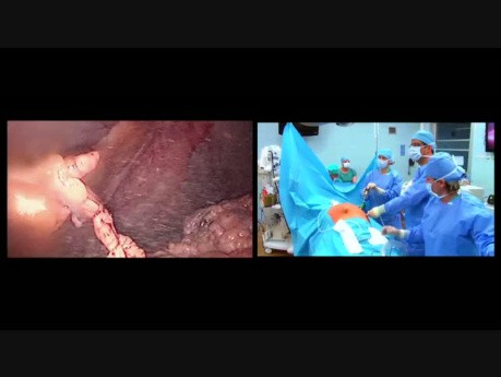 Die Operation  der ursprünglichen Nabelhernie mit der laparoskopischen Chirurgie IPOM