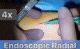 Endoskopische Radialarterienentnahme