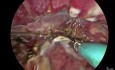 vNOTES-Hysterektomie bei Adenomyose