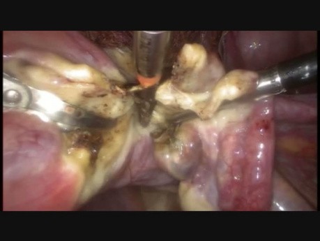 Sakrokolpopexie- Zustand nach drei Kaiserschnitt-Operationen