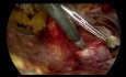 TEP-Leistenhernienreparatur mit selbstfixierendem Netz