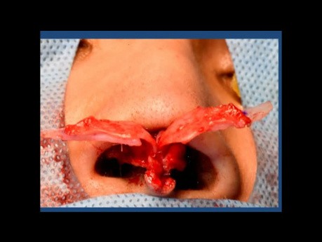 Korrektur einer unzureichend hervorstehenden Nasenspitze