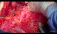Zytoreduktive Chirurgie bei Eierstockkrebs. Unbearbeitete Version. Teil II Mittlerer Bauch.