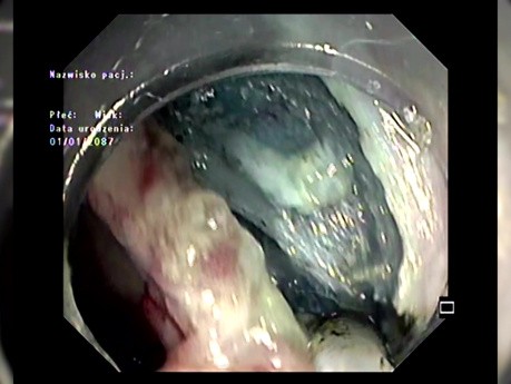 ESD benachbarter Läsionen einschließlich LST-G (laterally spreading tumor – granularer Typ)