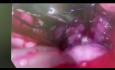 Uterusmyomektomie mit vNOTES (vaginal natural orifice transluminal endoscopic surgery)