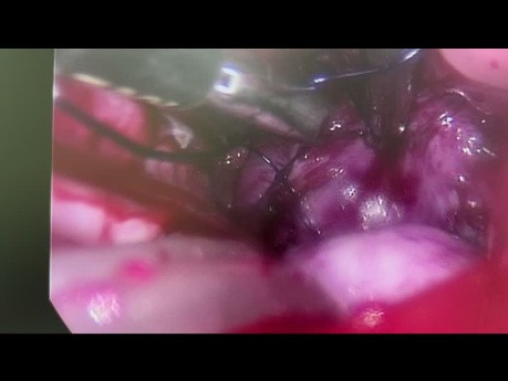 Uterusmyomektomie mit vNOTES (vaginal natural orifice transluminal endoscopic surgery)