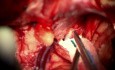 Linke extradurale optische Dekompression und Resektion eines kleinen TSM- und OGM-Meningeoms