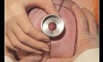 Reduktionsmammoplastik