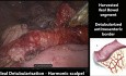 Roboter-assistierte laparoskopische Ileozystoplastik und Mitrofanoff-Appendix-Vesikostomie