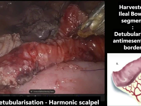 Roboter-assistierte laparoskopische Ileozystoplastik und Mitrofanoff-Appendix-Vesikostomie