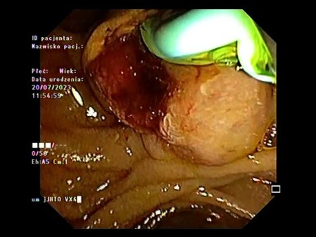 Papilläres Adenokarzinom, diagnostiziert mit EUS und ERCP