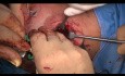 Intra+Extrakapsuläre Frakturen des Processus condylaris mandibulae - chirurgische Therapie