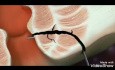 Lasertherapie bei der Analfistel