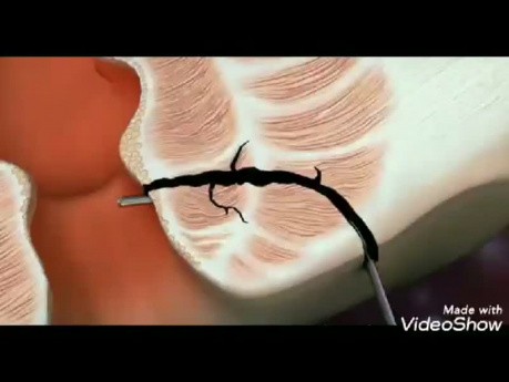 Lasertherapie bei der Analfistel