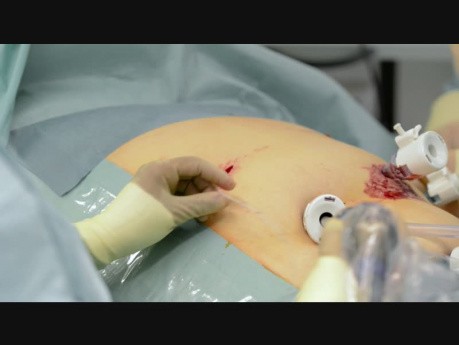  Chronische Schmerztherapie nach laparoskopischer Operation mit einem intraperitonealen Katheter