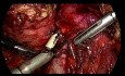 Totale laparoskopische Pankreatoduodenektomie (Whipple) bei Ampullenkrebs