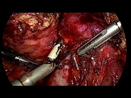 Totale laparoskopische Pankreatoduodenektomie (Whipple) bei Ampullenkrebs