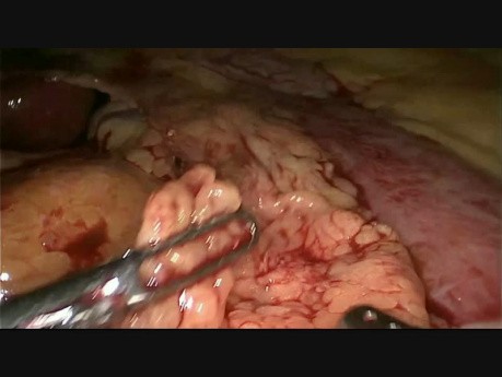 Laparoskopische distale Gastrektomie