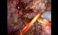 Die Rolle der roboterassistierten Chirurgie beim Klatskin-Tumor