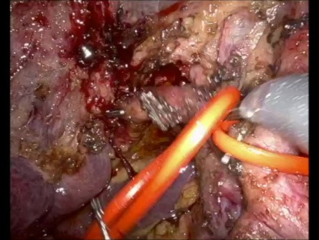 Die Rolle der roboterassistierten Chirurgie beim Klatskin-Tumor