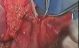 Operation für Magenkrebs- subtotale Gastrektomie