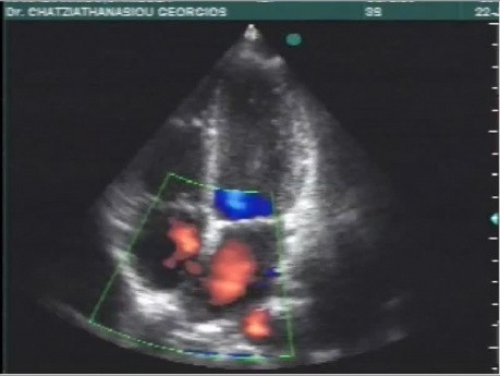 Kardiologie-Quiz Nr. 3 EKG und Echokardiogramm eines Patienten mit angeborener Herzkrankheit