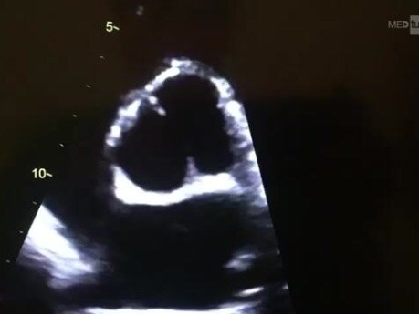 Echokardiographische Darstellung einer bikuspiden Aortenklappe in parasternaler Kurzachsenansicht