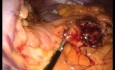 Laparoskopische Einzelzugangchirurgie distale Pankreatektomie und Splenektomie