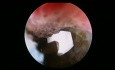 Adhäsive Kapsulitis