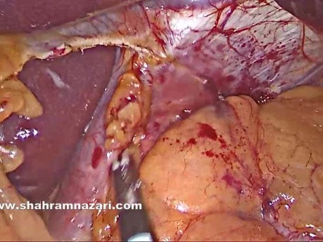 Der laparoskopische Ansatz für epiphrenische Divertikel mit Heller-Myotomie in der Achalasiechirurgie