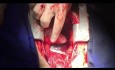 Schadensbegrenzende Operation bei Patienten mit Dissektion der aufsteigenden Aorta und Intimafalten