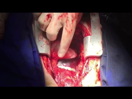 Schadensbegrenzende Operation bei Patienten mit Dissektion der aufsteigenden Aorta und Intimafalten