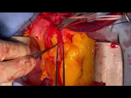 Behandlung einer ausgedehnten Dissektion der Aorta ascendens mit Aneurysma der rechten Koronararterie