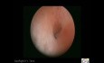 Endometriumproliferation und endometriale Polypen