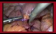 Die Technik des Nähens mit der laparoskopischen Methode