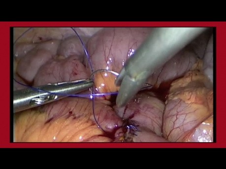 Die Technik des Nähens mit der laparoskopischen Methode