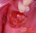 Antralschleimhautprolaps durch eine Zahnfach