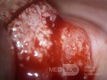 Zervikales Adenokarzinom (Carcinoma glandulare colli uteri)