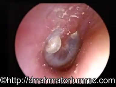 Bullöse Myringitis, verursacht durch einen Virus